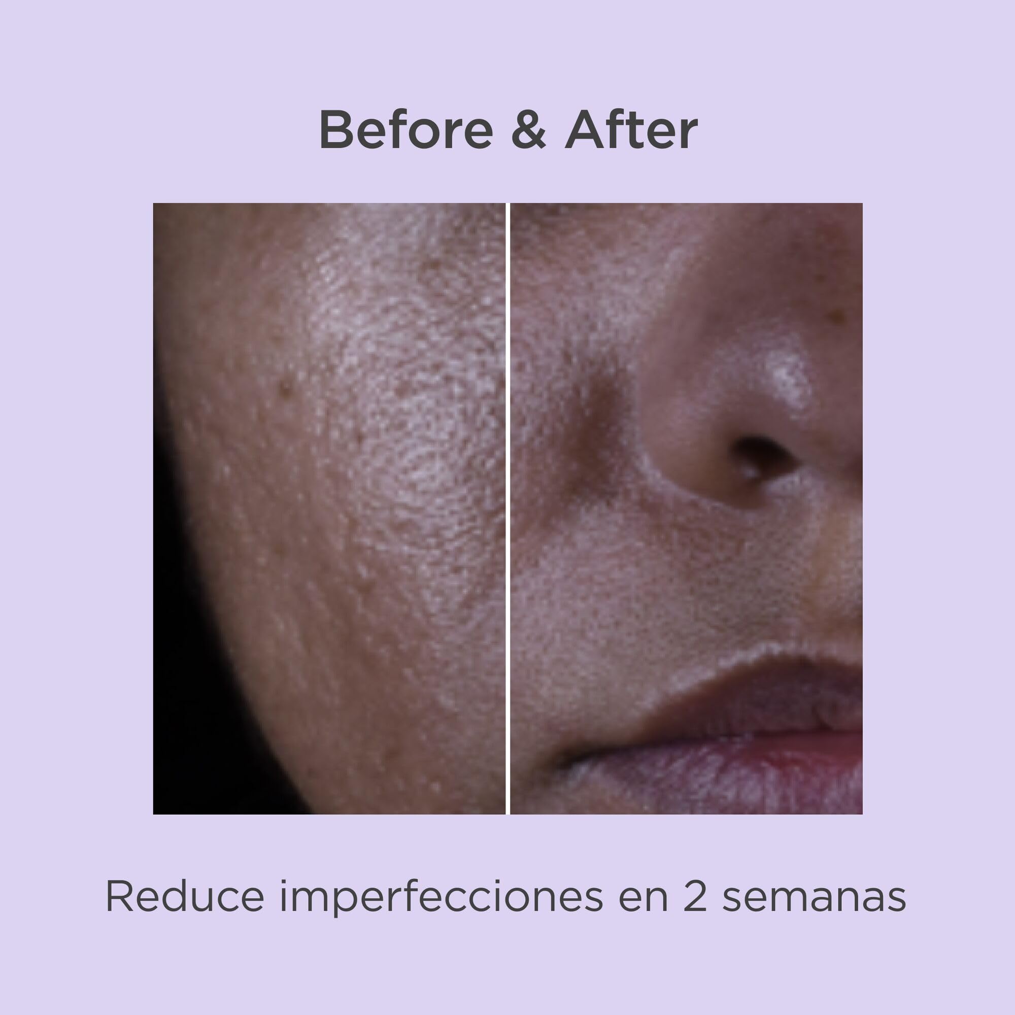 isdin-isdinceutics-salicylic-renewal-s-rum-antiimperfecciones-con-cido-salic-lic image 8