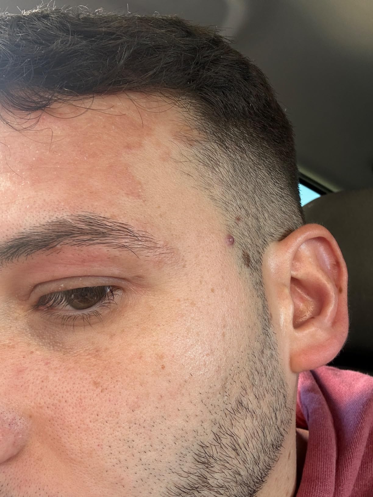 Perfecta para pieles psoriásicas